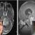 هدفگیری سرطان مغز کودکان با ترکیب دارویی محققان ایرانی