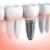 راهکار اساسی کاهش شاخص پوسیدگی دندان/صنعت ایمپلنت در حال فراگیر شدن