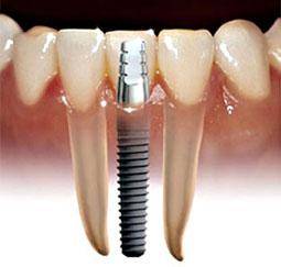 رئیس انجمن دندانپزشکان ایران از آغاز مراحل ساخت ایمپلنت در کشور خبر داد.