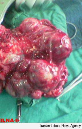 خارج کردن تومور 10 کیلویی از شکم دختر کاشمري (+عکس)