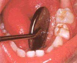 دندانپزشكی پیشگیری نقش بسزایی در سلامت افراد جامعه دارد