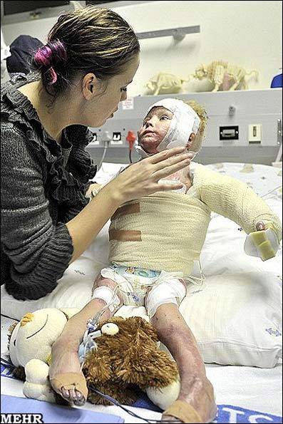نخستین تصاویر کودکی پس از پیوند پوست/ بهبود پس از 80درصد سوختگی