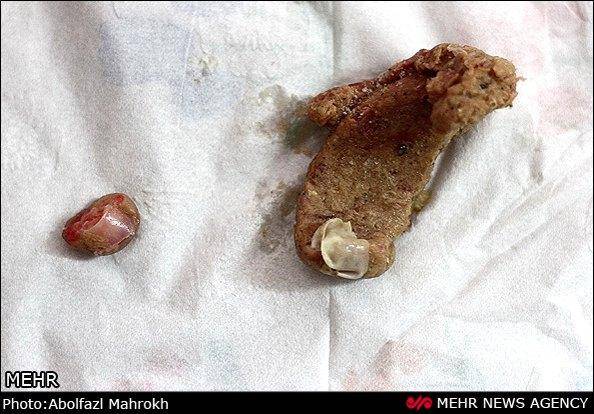 پیدا شدن انگشت دست انسان در بسته همبرگر در قم (تصاویر)