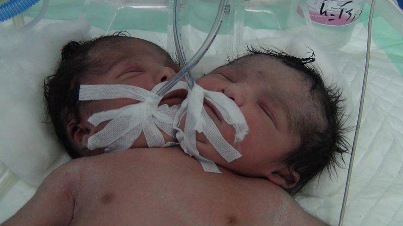 تولد نوزادی دو سر در دزفول!/تصاویر