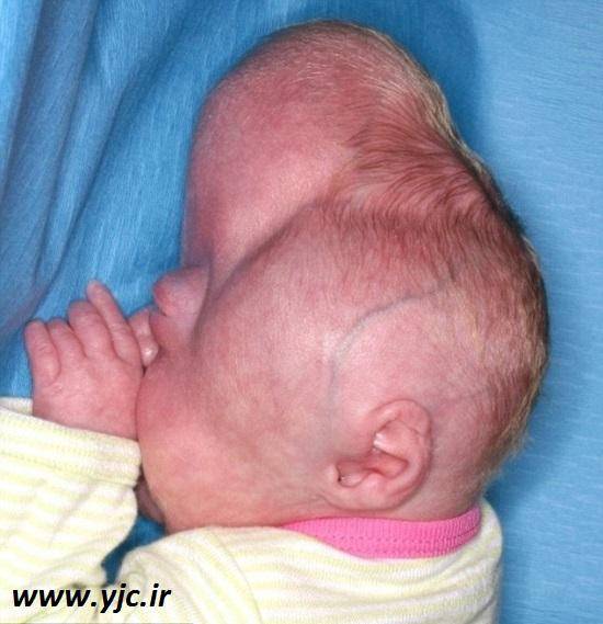کودکی با بدشکل ترین جمجمه دنیا/تصاویر