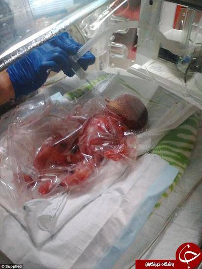 زنده ماندن عجیب بچه‌ای که ۳ ماهه بدنیا آمد +تصاویر