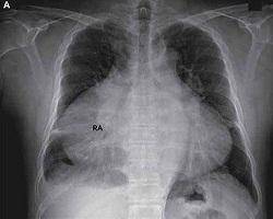 قلب غول‌پیکر مرد ۵۷ ساله + عکس
