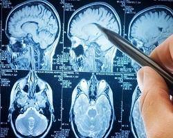 تومور مغزی در کمین افراد باسواد