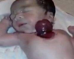 نوزادی که قلبش خارج از بدنش می‌تپد + عکس