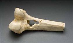 ورزش‌های ممنوع برای افراد مبتلا به پوکی استخوان/ روش‌های درمانی غیرجراحی پوکی استخوان را بشناسید