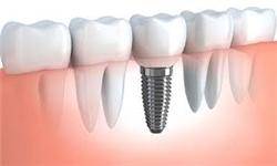 راهکار اساسی کاهش شاخص پوسیدگی دندان/صنعت ایمپلنت در حال فراگیر شدن