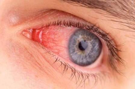 درمان عفونت چشم با نانواسفنج