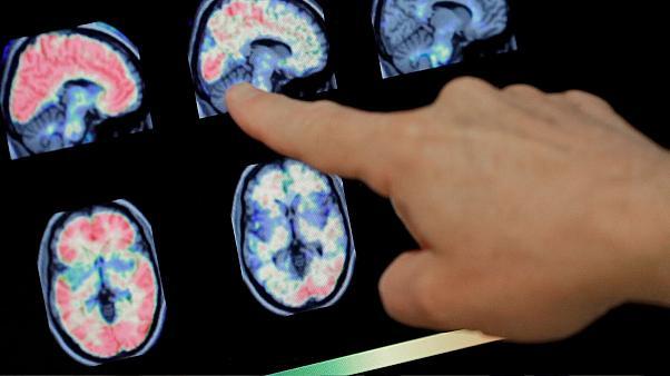  یافته جدید محققان در خصوص تاثیر مخرب ویروس کرونا بر مغز