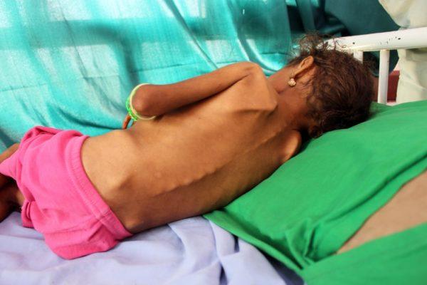 هشدار سازمان ملل درباره احتمال فروپاشی نظام بهداشتی یمن