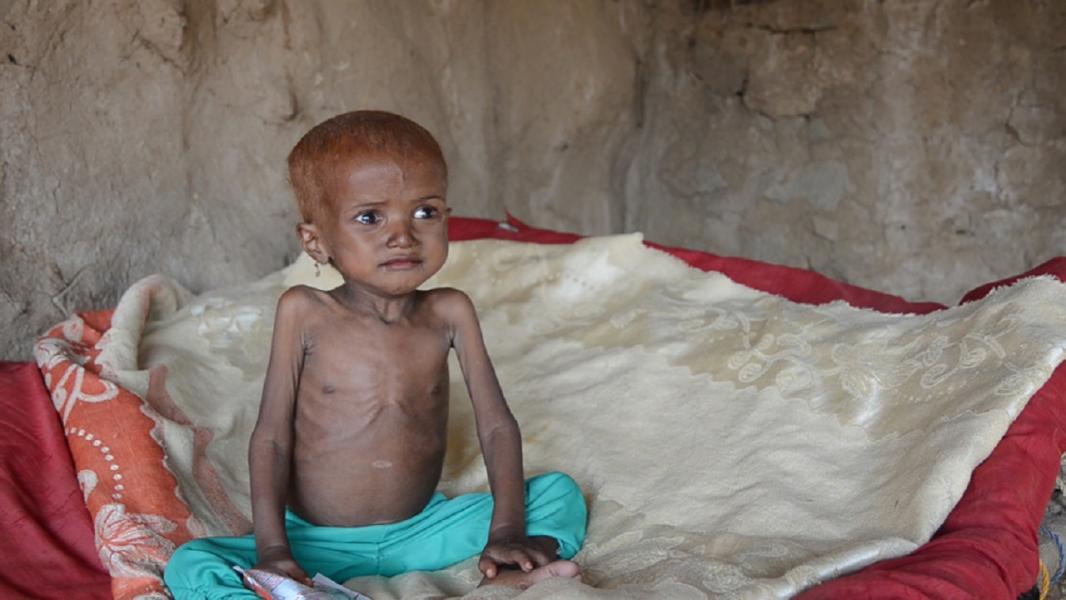 وزیر بهداشت یمن: هر ۵ دقیقه، یک کودک یمنی درپی سوءتغذیه می‌میرد