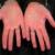 اختلال در عملكرد انگشتان با تزريق زياد بوتاكس 