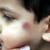 وزیر بهداشت: شیوع بیماری سالک در 17 استان کشور