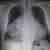 قلب غول‌پیکر مرد ۵۷ ساله + عکس