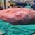 عکس| توده ۹ کیلوگرمی از شکم یک بیمار در یاسوج خارج شد