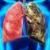 مهمترین نشانه‌های سرطان ریه