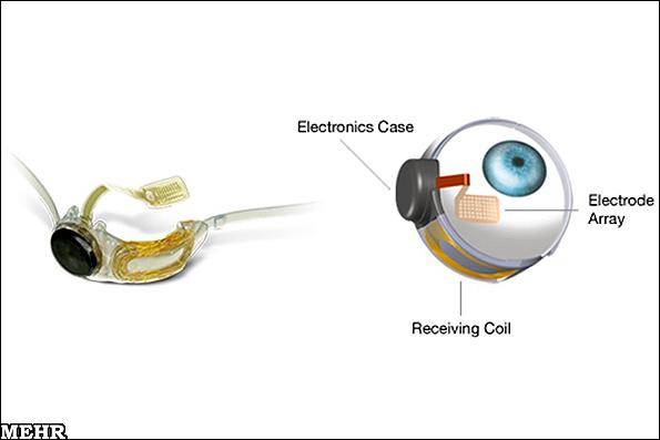 تولید انبوه شبکیه مصنوعی در اروپا/ درمان 30 نابینا با شبکیه مصنوعی