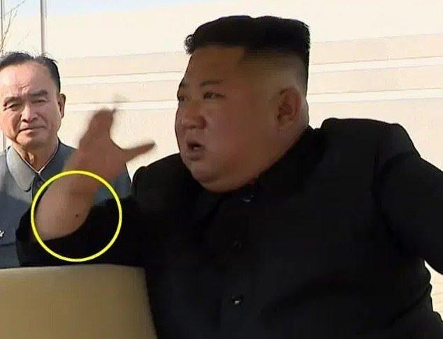 جای سوزن بر مچ کیم جونگ اون؛ رهبر کره شمالی عمل جراحی انجام داده است؟+عکس