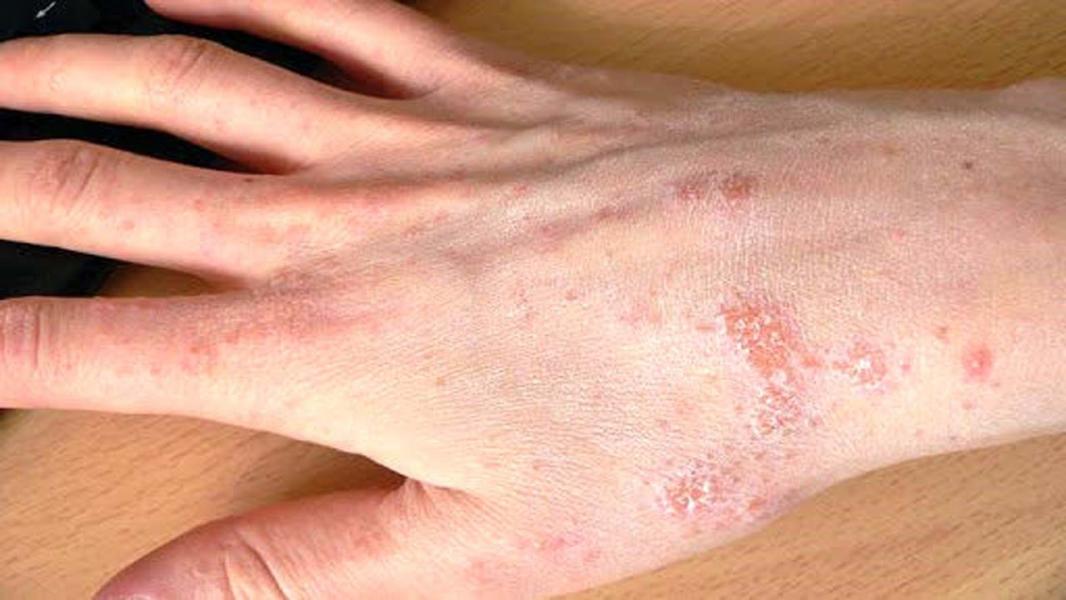 ۶ نشانه بیماری که از روی پوست مشخص است