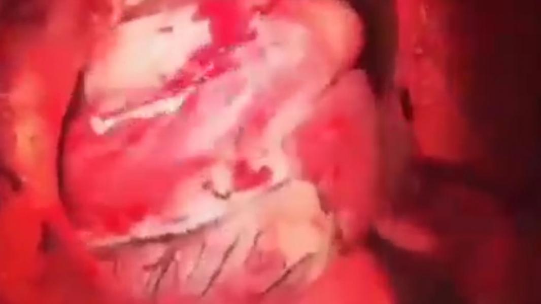 تلفیق شنیدنی ریتم تپش قلب و موسیقی + صوت