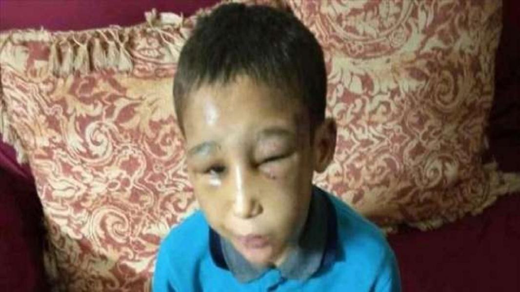 شکنجه های دردآور پسربچه هشت ساله به دست والدین معتادش