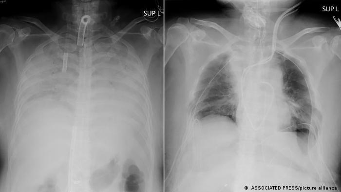 اولین پیوند ریه جهان از اهداکننده زنده به بیمار مبتلا به کووید ۱۹