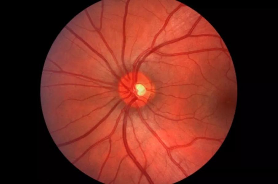 عارضه «نوریت اپتیک» را بشناسیم / ‏‬اختلال در بینایی فرد مبتلا