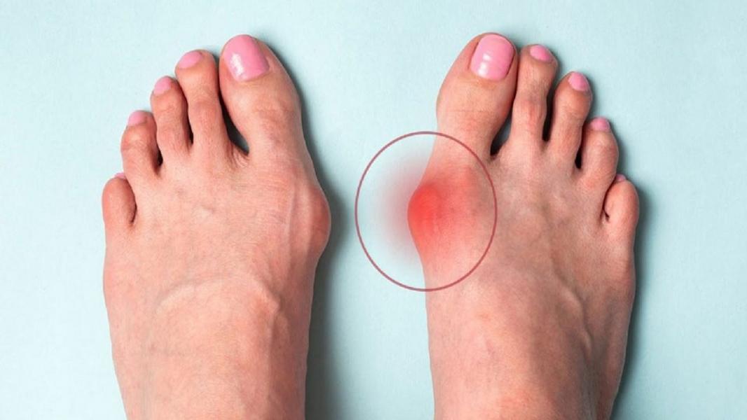 انحراف شست پا را چگونه درمان کنیم؟/ مصرف روزانه گیلاس موجب چه تغییراتی در بدن می‌شود؟/ تقویت مژه‌ها با ۸ ترفند ساده