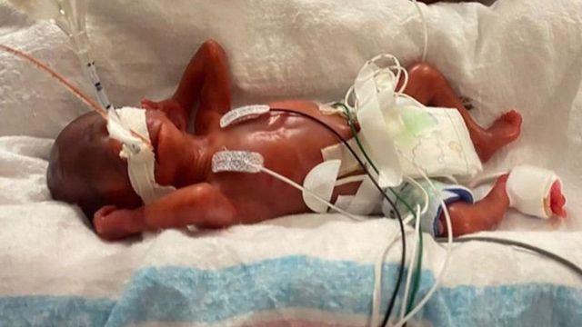 زودرس‌ترین نوزاد جهان: پسری که ۱۹ هفته زود به دنیا آمد