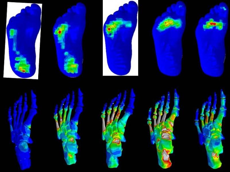 بررسی انگشتان پای دیابتی‌ها برای طراحی کفش و کفی طبی