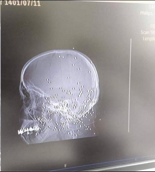 گاردین: نیروهای امنیتی ایران «بطور عمد» به صورت و اندام جنسی زنان شلیک می‌کنند