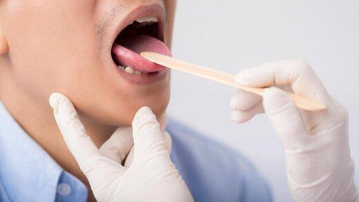 علائم شایع سرطان دهان