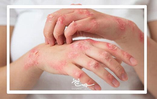 پسوریازیس چیست و چگونه درمان می‌شود؟