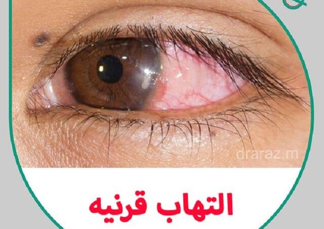 التهاب قرنیه چشم چیست؟