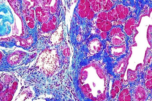 کشف پروتئین قاتلی که باعث سرطان لوزالمعده می‌شود