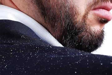 رفع شوره سر و ریزش مو با این راهکارهای خانگی