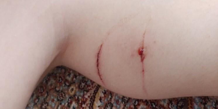 حمله سگ‌ به پسر ۱۲ ساله در مرکز شهر تبریز