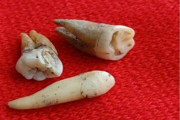 استخراج پادتن زنده از دندان‌های ۸۰۰ ساله/ عکس