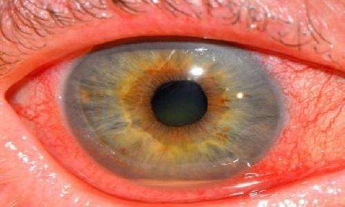 دو بیماری چشم که با خطر نابینایی همراه است / توصیه به دیابتی‌ها و سالمندان