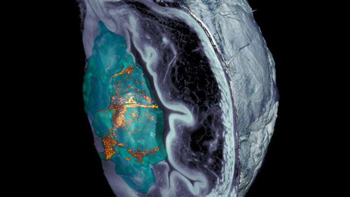 تومور سرطان مثانه در موش‌ها با «نانوربات» ۹۰ درصد کوچک‌تر شد