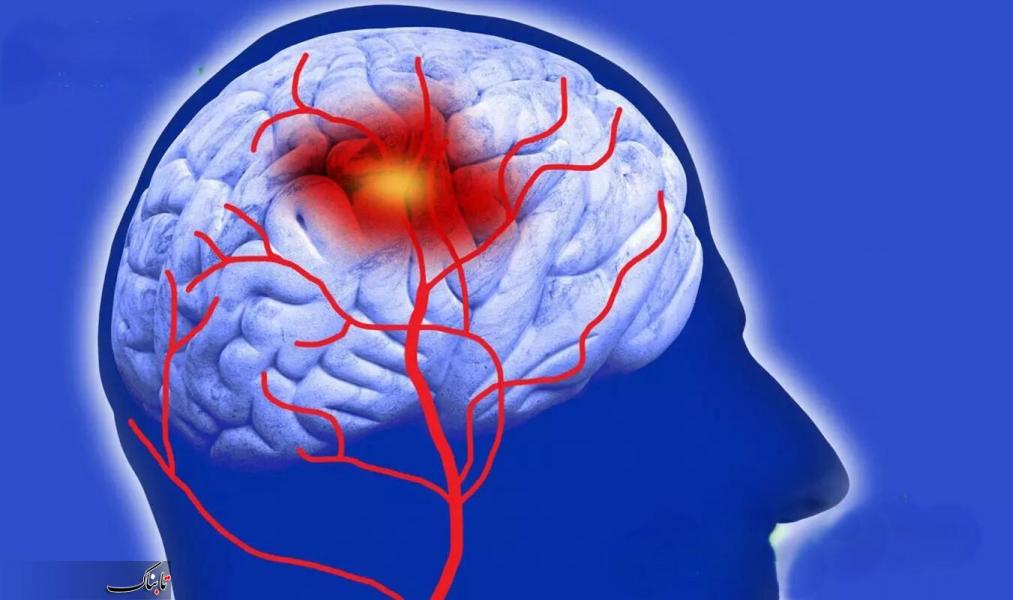 درمان‌های مناسب برای سکته مغزی