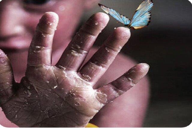 جزییات بیماری‌های نادر دارای بسته خدمتی تحت پوشش صندوق صعب‌العلاج