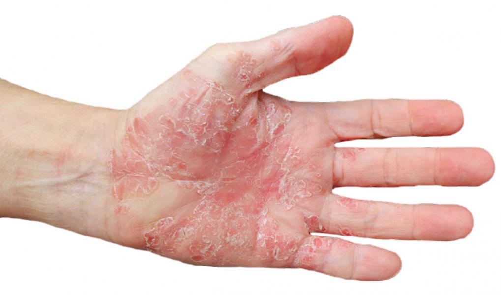 زندگی سخت با یک بیماری چالش‌برانگیز!