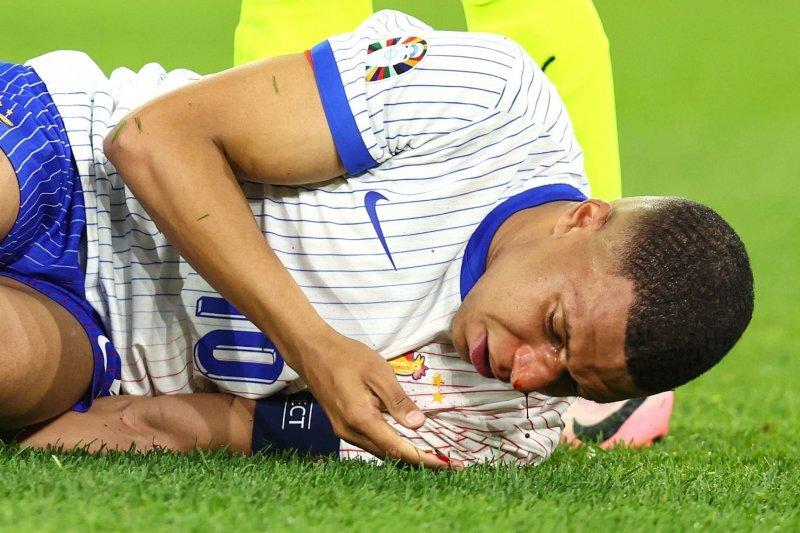 امباپه با محافظ بینی +عکس